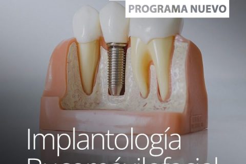 Implantología Bucomáxilofacial